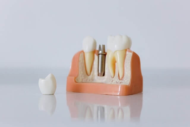 ugradnja zubnih implantata